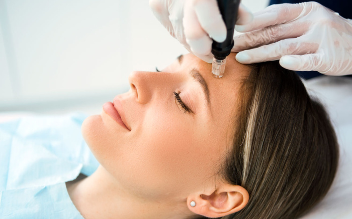 Microneedling